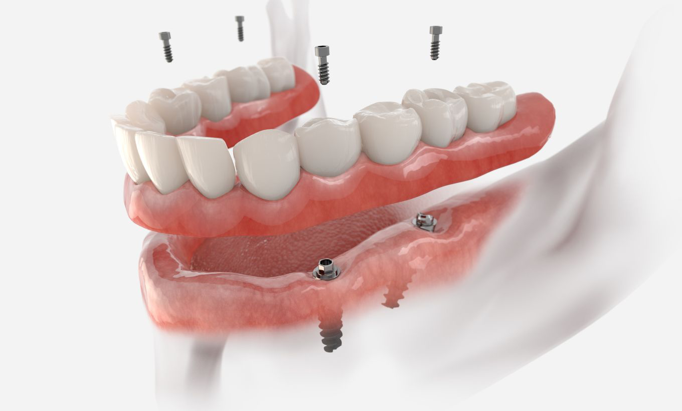 Implant Supported Prosthesis