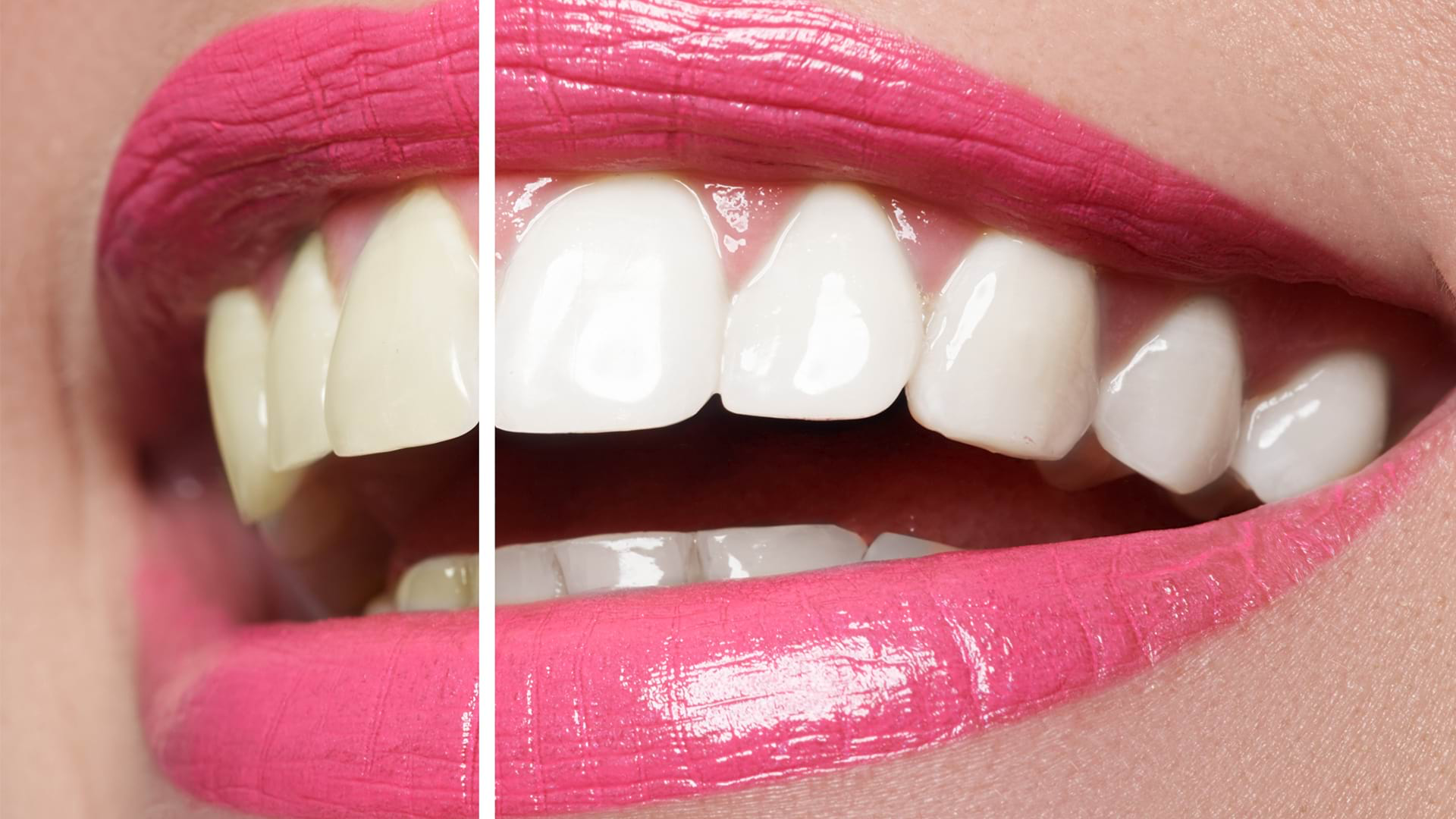 Smile Design Treatment